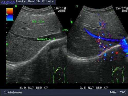 肝臟腹部的超音波影像