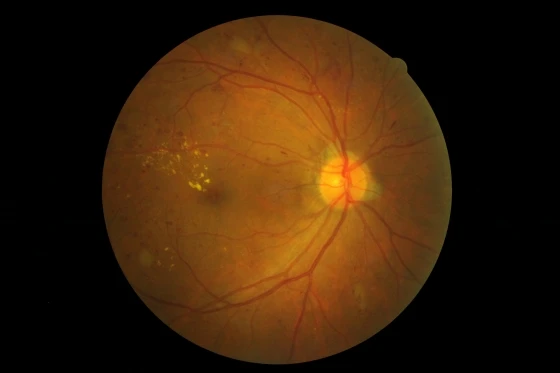眼底攝影-PPDR增生前糖尿病視網膜病變