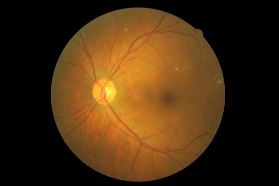 眼底攝影-BDR 背基型糖尿病視網膜病變