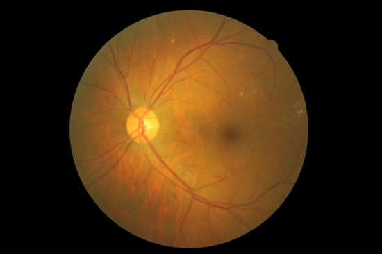 眼底攝影-BDR 背基型糖尿病視網膜病變