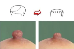 乳頭過大或過長術前術後圖