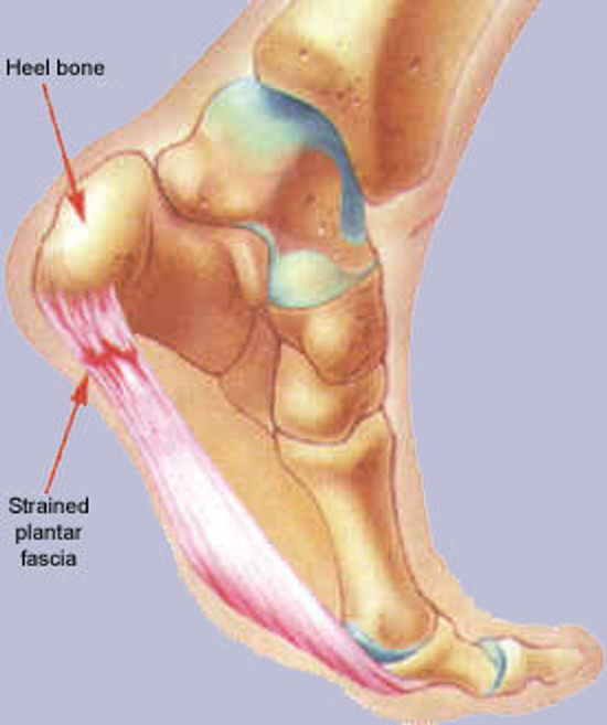 足底筋膜炎(足跟會痛)