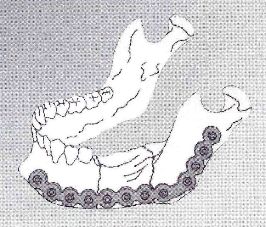 下顎重建骨釘骨板系統