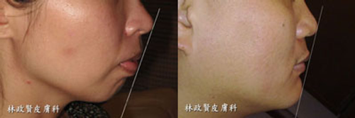 玻尿酸、微晶瓷微整形墊下巴,寬圓U型臉變V型鵝蛋臉唷~