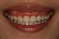 水雷射牙齦整形 牙冠增長術+牙脊整形術+上唇定位術