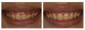 水雷射牙齦整形 牙冠增長術+牙齦淨白術 ★ 自然大
